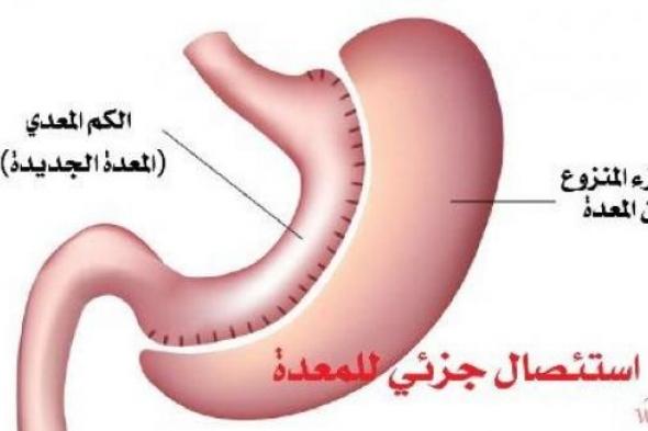 أعراض وأسباب سرطان المعدة وطرق الوقاية