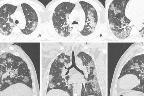 كورونا يثير ألغازاً محيرة في رئتيي المرضى