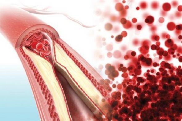 أعراض تشير الي الإصابة بتصلب الشرايين.. أغربها فقدان الشهية