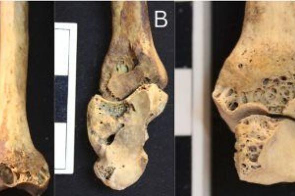 الكشف عن أقدم حالة لإلتهاب المفاصل الروماتويدى في مصر القديمة حتى الآن