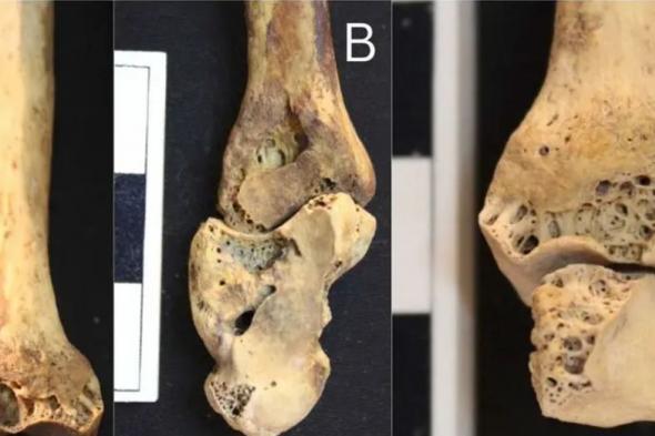 الامارات | العثور على الهيكل العظمي لأول امرأة مصرية أصيبت بالتهاب المفاصل قبل آلاف السنين