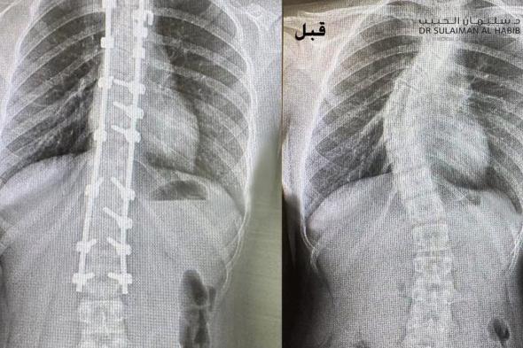 السعودية | مستشفى الدكتور سليمان الحبيب بالعليا يُعيد فتاة لحياتها الطبيعية بعد جراحة جنف متقدمة استغرقت 5 ساعات