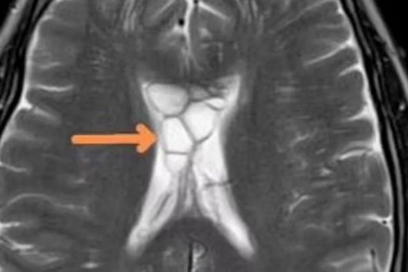 الامارات | صداع حاد لأربعة أشهر والسبب دودة في الدماغ فمن أين جاءت ؟