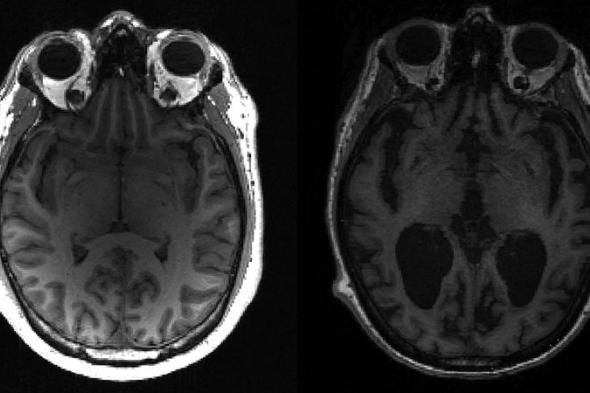 الامارات | منظومة للتنبؤ بالزهايمر عن طريق الذكاء الاصطناعي