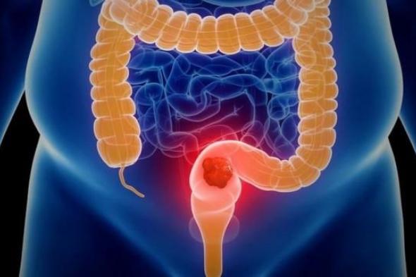 الامارات | دراسة: اختبار دم بسيط قادر على الكشف مبكرا عن الإصابة بسرطان القولون