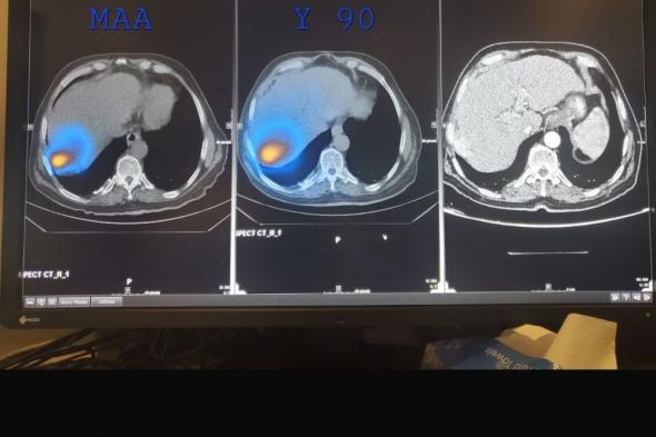 فريق بمدينة الملك فهد الطبية ينجح في علاج مريض سرطان كبد بالحبيبات المشعة